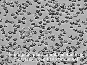 400× magnification of slide-mounted bronchial brushing sample.