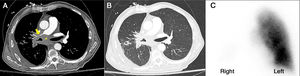 Axial contrast-enhanced chest CT with mediastinal (A) and lung (B) windows shows conglomerate tumor (yellow asterisk) in the right hilar and subcarinal space with narrowing of the right bronchus intermedius and right distal main (yellow arrow) pulmonary artery. Quantitative lung perfusion scintigraphy (C) revealed nearly absent perfusion of right lung.