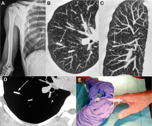 (A) Anteroposterior radiograph of the right humerus showing a small, dense linear projection in the right hemithorax (arrow). (B and C) Axial and coronal reconstructed images depicting the device lodged in a vascular branch of the right lower lobe of the lung (arrows). (D) Axial CT image (obtained with the mediastinal window setting) showing the small metallic device (arrow). (E) The biochip being implanted in the patient