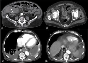 A and B: Abdominal CT 1A: Enlarged gallbladder (asterisk) containing lithiasis (arrow) and free gas in the wall of the gallbladder (circled), indicative of emphysematous cholecystitis. 1B: Pouch of Douglas containing free fluid (asterisk) and lithiasis (arrow), showing bilioperitoneum. C and D: Chest CT. 1C: Upper chest slices; mediastinal collection containing air (asterisk); esophagus (circled); bilateral pleural effusion (arrows). 1D: Thoracoabdominal sections; diaphragmatic domes (arrow); retroperitoneal air (circled) progressing to the chest.