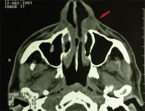 Exame tomográfico em corte axial demonstrando imagem hipodensa extra-óssea bem circunscrita na região de asa do nariz esquerda.