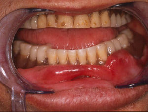 Clinical presentation of a lower epulis fissuratum with protheses.