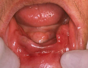 Clinical presentation of a lower epulis fissuratum without protheses.