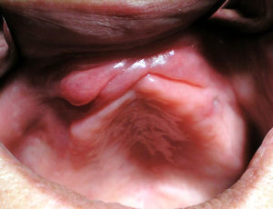 Clinical presentation of a upper epulis fissuratum without protheses.
