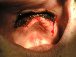Aspect of surgical wound after carbonization to ensure haemostasis.