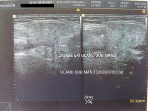 Ultrassonografia apontando a presença de uma lesão focal ecogénica sugestiva de sialolito na mesma região indicada pela radiografia oclusal.