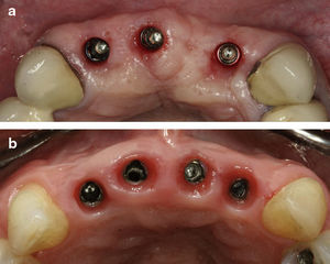 a) Reabilitação dos 4 incisivos com a colocação de 3 implantes b) - Reabilitação dos 4 incisivos com a colocação de 4 implantes.