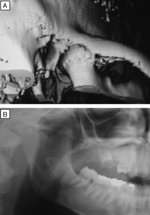 (A e B): Tomografia computadorizada em 3D (A) e ortopantomografia (B) mostrando alteração no côndilo mandibular.