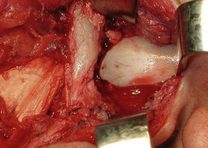 Remoção do tecido patológico e artroplastia do côndilo remanescente.