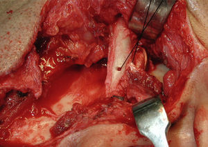Retalho da fáscia e músculo temporal rodado abaixo do arco zigomático, interposicionado entre a fossa articular e o côndilo remanescente e suturado no arco zigomático.