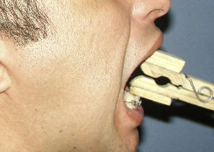 Fisioterapia para abertura bucal.