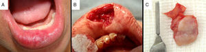 A: tumor em lábio inferior direito; B: loca cirúrgica após biópsia excisional; C: peça biopsiada.