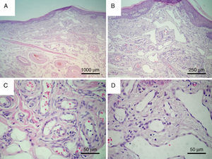 Secções histológicas coradas em HE. (A) Visão panorâmica da mucosa labial exibindo revestimento epitelial escamoso atrófico (e) e, na lâmina própria subjacente (LP), componente vascular exuberante (cv); na profundidade, observa-se submucosa rica em vasos arteriolares (ar), fibras musculares estriadas (fm) e tecido adiposo (ta). (B) Destaque para o componente vascular constituído por vasos capilares delicados (*). (C) Maior aumento dos vasos capilares de parede ora mais espessa e (D) ora delgada.