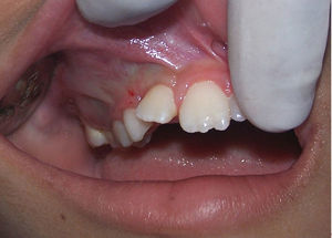 Intraoral photograph revealing a bluish swelling in right primary molar region and tilting of the right permanent lateral incisor.