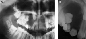 Panoramic (A) and periapical (B) radiographs showing a well-defined radiolucency in the right maxilla. Note the displacement of the permanent cuspid to the floor of orbit.