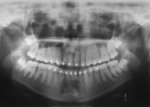 Panoramic radiograph after a 4-year follow-up. There were no findings of recurrency.