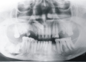 Imagem radiográfica da lesão localizada em corpo mandibular.