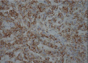 Corte com imuno-histoquímica, 20×, positivo difuso para o marcador: CD45LCA (Antígeno leucocitário comum).