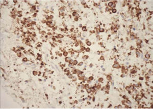 Corte com imuno-histoquímica, 20×, positivo difuso para o marcador: VS38 (Células plasmáticas).