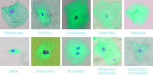 Tipos celulares encontrados em células orais esfoliadas, marcadas com reagente de Schiff e Light green, analisadas por microscopia ótica. Ampliação: 400X.
