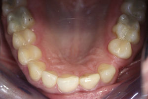 Fotografia inicial intra-oral oclusal.
