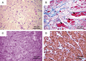(A) Secção histológica corada em HE, caracterizada pela proliferação de células com o citoplasma granular no tecido conjuntivo subjacente. (B) Através da coloração de Masson, percebe-se a presença de células poligonais granulosas (a vermelho, indicadas pelas setas), de algumas fibras musculares (a vermelho) e de fibras colágenas (a azul). (C) Positividade citoplasmática das células neoplásicas para o PAS. (D) Secção histológica submetida à marcação imuno-histoquímica (LSAB) para proteína S-100, mostrando positividade no parênquima tumoral.
