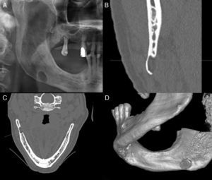 (A) Panoramic radiograph showing a well-demarcated, unilocular radiolucent area in the lower right angle of the mandible. Axial (B) and coronal (C) cone-beam CT showing a lingual opening of the PL-MBD. (D) CT with three-dimensional reconstruction image.