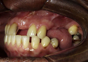 Foto da paciente 5 anos após a extração do 2.° molar superior esquerdo. Neste momento, ainda não tinha sido realizada a biópsia incisional.