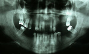 Radiografia panorâmica antes da realização da biópsia.