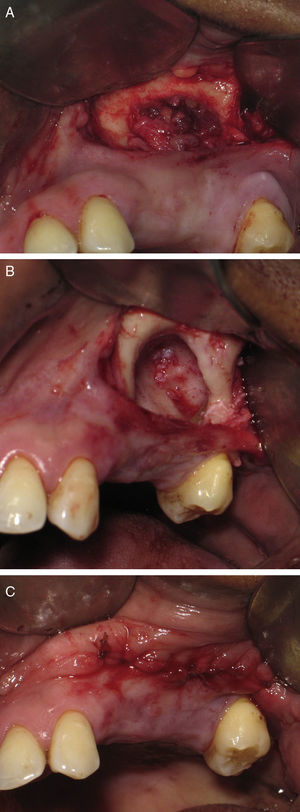 (A) Foto intraoperatória mostrando a lesão cística. (B) Foto intraoperatória mostrando a total remoção da lesão por meio de enucleação.