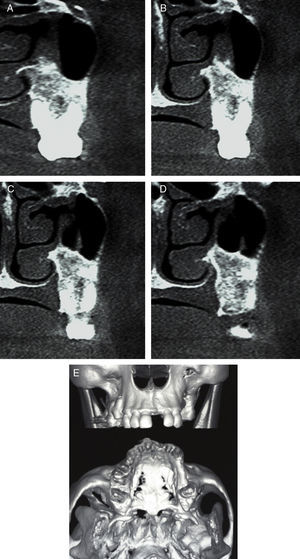 Tomografia computadoriza em corte parassagital mostrando a região operada.