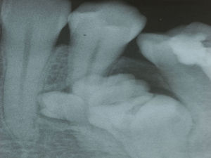 Radiografia periapical mostrando área radiopaca com estruturas mineralizadas semelhantes a pequenos dentes localizado nos ápices dos dentes 34 e 35.