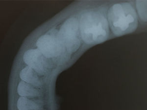 Radiografia oclusal indicando a extensão V-L da lesão.