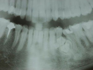 Vista geral através de radiografia panorâmica mostrando área radiopaca na proximidade do canal mandibular na região de forame mentual.