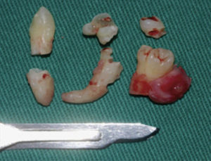 Espécime cirúrgico dos dentículos do odontoma.