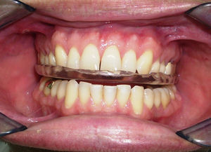 Aparelho instalado na boca. Observar que a superfície oclusal plana do aparelho não permite contactos em todos os dentes. Procura-se um número de contactos suficientes para estabilizá-lo durante os movimentos mandibulares, contudo, sem modificar a sua característica plana.