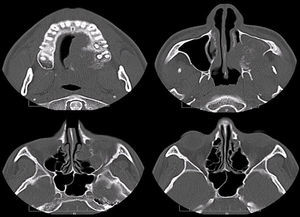 Tomografia computadorizada em cortes axiais com janela para tecido ósseo mostrando imagem expansiva e destrutiva, hipodensa com áreas hiperdensas no seu interior, estendendo-se do palato duro à porção inferior da órbita, no lado esquerdo, ocupando o seio maxilar e proporcionando destruição das suas paredes medial e lateral.