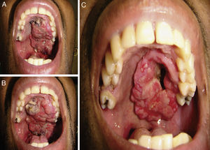 A) Aspeto clínico da lesão após 8 dias da biópsia incisional. B) Aspeto clínico da lesão após 18 dias da biópsia incisional, exibindo um aumento do tumor na região onde foi realizada a biópsia. C) Aspeto clínico da lesão, 60 dias após início do tratamento quimioterapêutico, evidenciando a redução parcial do tumor e comunicação bucossinusal.