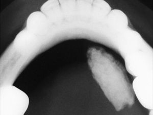 Radiografia oclusal evidenciando massa radiopaca de formato cilíndrico e alongado na região correspondente ao ducto da glândula submandibular.