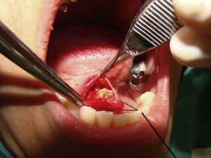 Excisão em soalho bucal direito associado a dissecção completa do ducto e localização do cálculo.