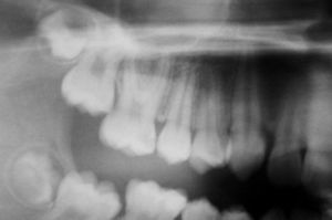 Initial radiograph of tooth 16.