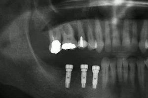 Initial radiograph of tooth 16.