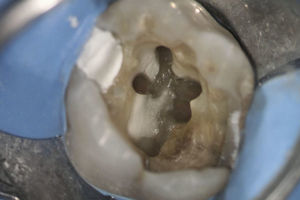 Endodontic access opening of tooth 16. Five root canals could be identified.