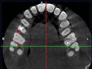 CBCT image from tooth 16 before endodontic treatment. Five root canals can be visualized (arrows).