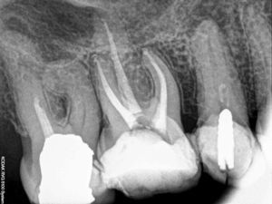 Final periapical radiograph of the endodontic treatment on tooth 16.