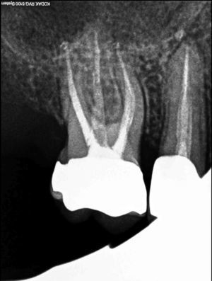 10 months recall of the third reported case shows no clinical or radiographic findings.