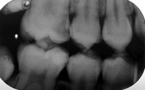 Initial bitewing radiograph of tooth 16. A large mesial decay can be seen.