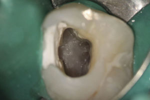 Endodontic access opening of tooth 16. Five root canals could be found.