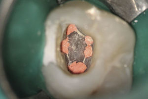 Obturation of the five root canals of tooth 16.