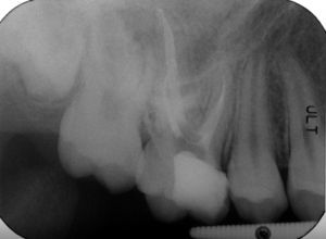 Final periapical radiograph of the endodontic therapy on tooth 16.